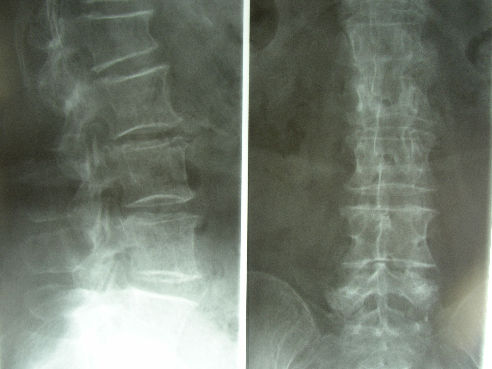 Radiographie lombaire